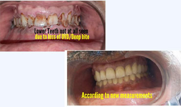 Mouth Breathing Treatment