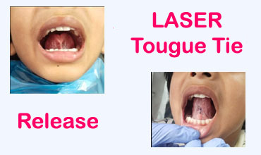 Full Mouth Rehabilitation