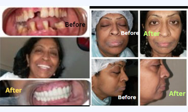 TMD dental treatment
