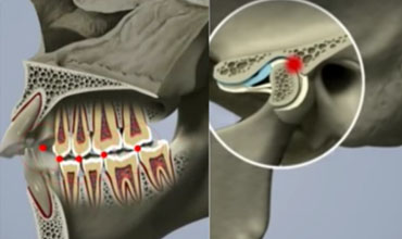 TMD dental treatment