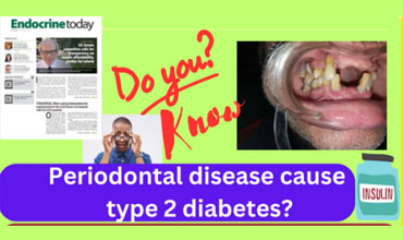 Diabetes and Dental Caries