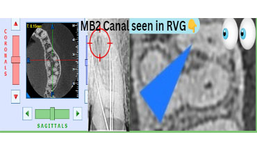 Endodontic Treatment