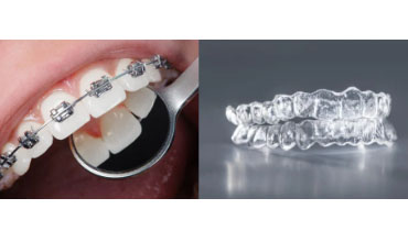 Orthodontic Treatment