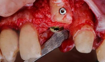 Bone Augmentation and Grafting