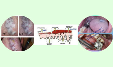 Oral Lesions & Laser Surgeries